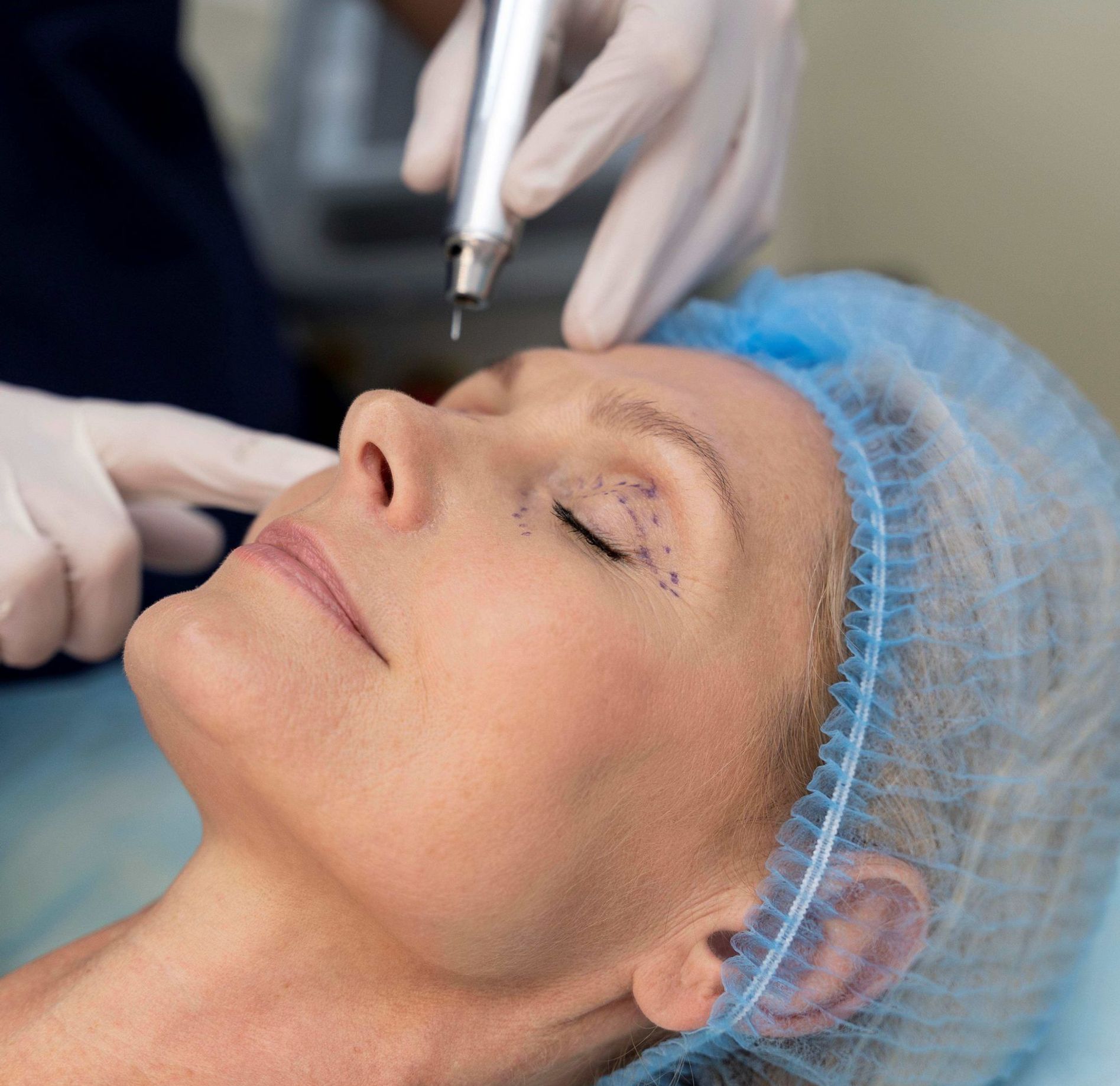 Descubra como a combinação de blefaroplastia e preenchimento facial pode rejuvenescer o seu rosto, promovendo harmonia e realçando sua beleza natural.
